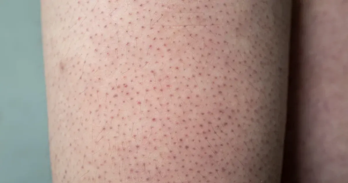 Чому взимку на руках з'являються червоні висипання: лікар пояснила головну причину.