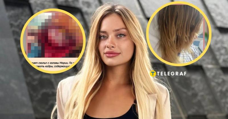 З шрамами на обличчі та в інвалідному візку: українську модель, яка зазнала нападу в Дубаї, важко впізнати (фото, відео)